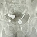 Patient with tummy ache leaves doctors speechless as they find strange object in stomach