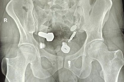 Patient with tummy ache leaves doctors speechless as they find strange object in stomach
