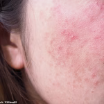 Have YOU got ‘autumn face’? Why your skin flares up when the weather turns cold – and how to fix it, according to a top dermatologist