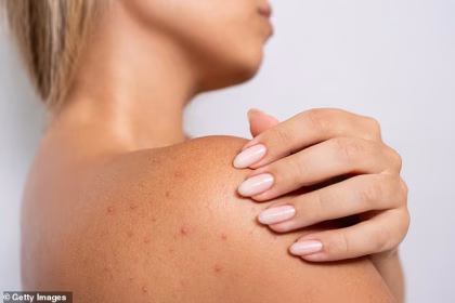 I’ve got sudden terrible back acne. It’s extremely uncomfortable and I can’t get rid of it. What should I do? DR ELLIE reveals the little-known condition that could be to blame… and how to get rid of it for good