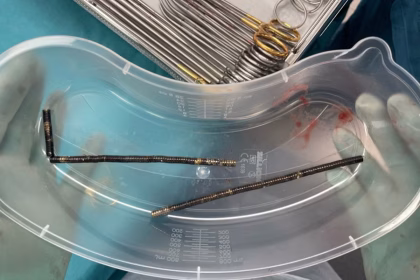 New Zealand teen undergoes surgery after swallowing up to 100 strong magnets ordered on Temu