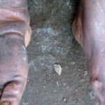 Delta govt offers free surgeries for hydrocele, lymphatic filariasis patients