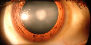 Mainstream pushes to end rising cataract cases with 2,000 free surgeries