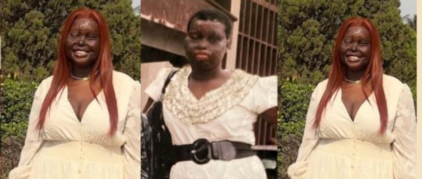 “I Almost Lost My Smile” – Burn Survivor Recounts Painful Childhood Acid Attack