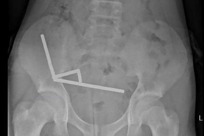 Boy, 13, Has Part of Bowels Removed After Swallowing Up to 100 Magnets Allegedly Purchased on Temu