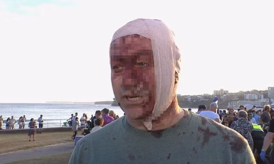 Bloodied and bandaged Bondi beach terror attack victim declares ‘I lived through Oct 7th. Never imagined I’d see this horror in Australia’