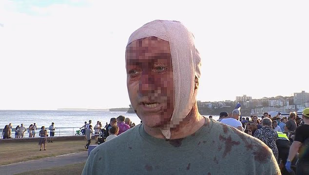 Bloodied and bandaged Bondi beach terror attack victim declares ‘I lived through Oct 7th. Never imagined I’d see this horror in Australia’