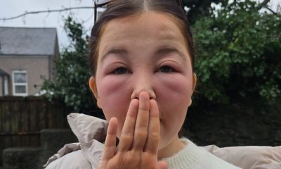 Mum’s urgent warning after Primark product left daughter ‘swollen and unrecognisable’