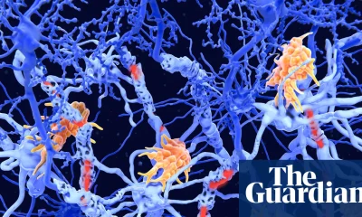 Two new subtypes of MS found in ‘exciting’ breakthrough | Multiple sclerosis