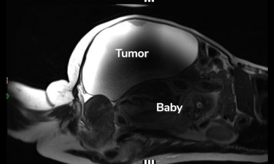 ‘Unprecedented’: Woman delivers full-term abdominal pregnancy while also having 22-pound cyst removed